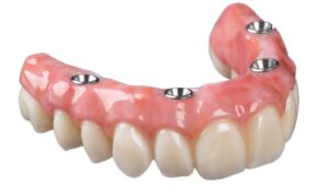 partial dentures tamworth