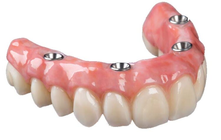 partial dentures tamworth