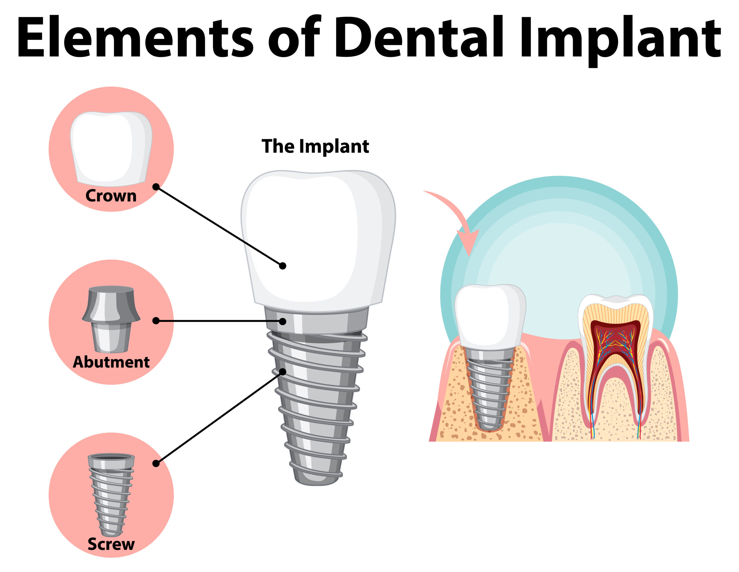 Dental Implant structure