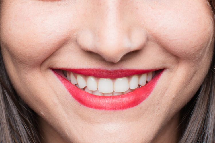 Centrepoint Dental teeth whitening Tamworth