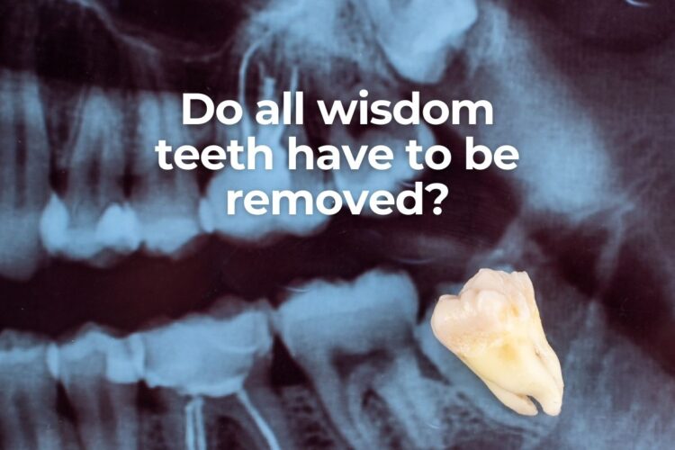 should all wisdom tooth be removed