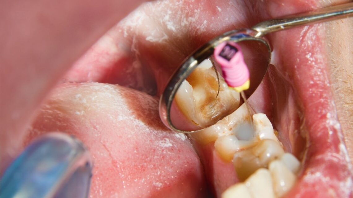 when to consider tooth extraction and root canal