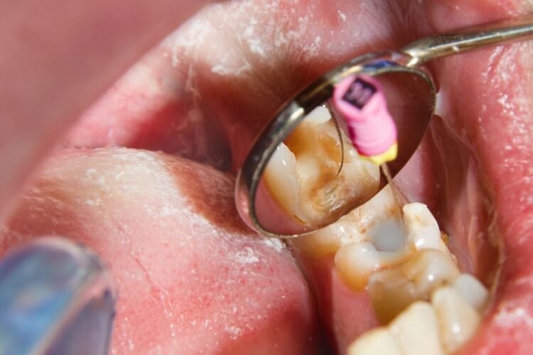 when to consider tooth extraction and root canal
