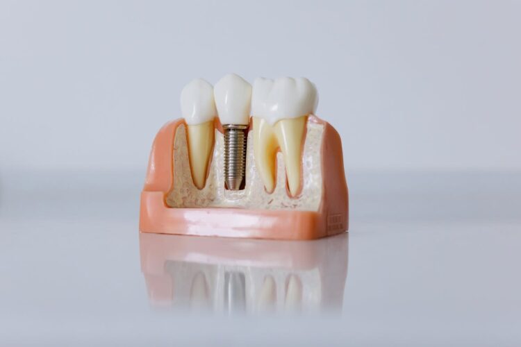 What Happens If You Delay a Dental Implant