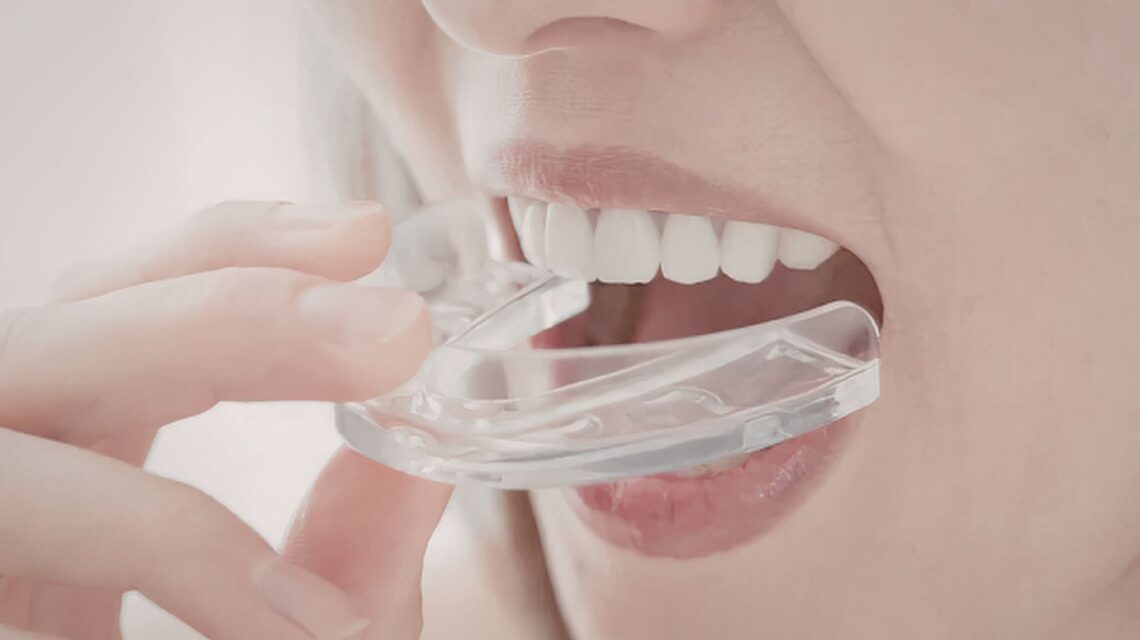 mouthguards Tamworth