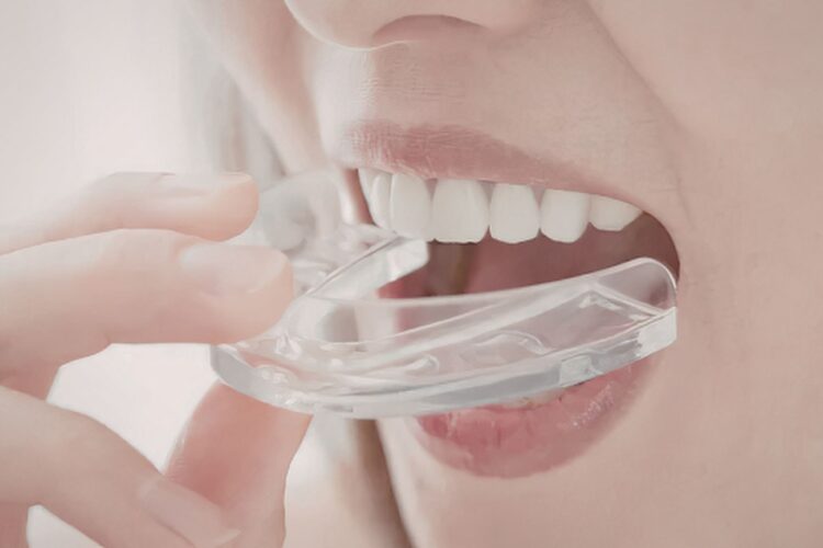 mouthguards Tamworth