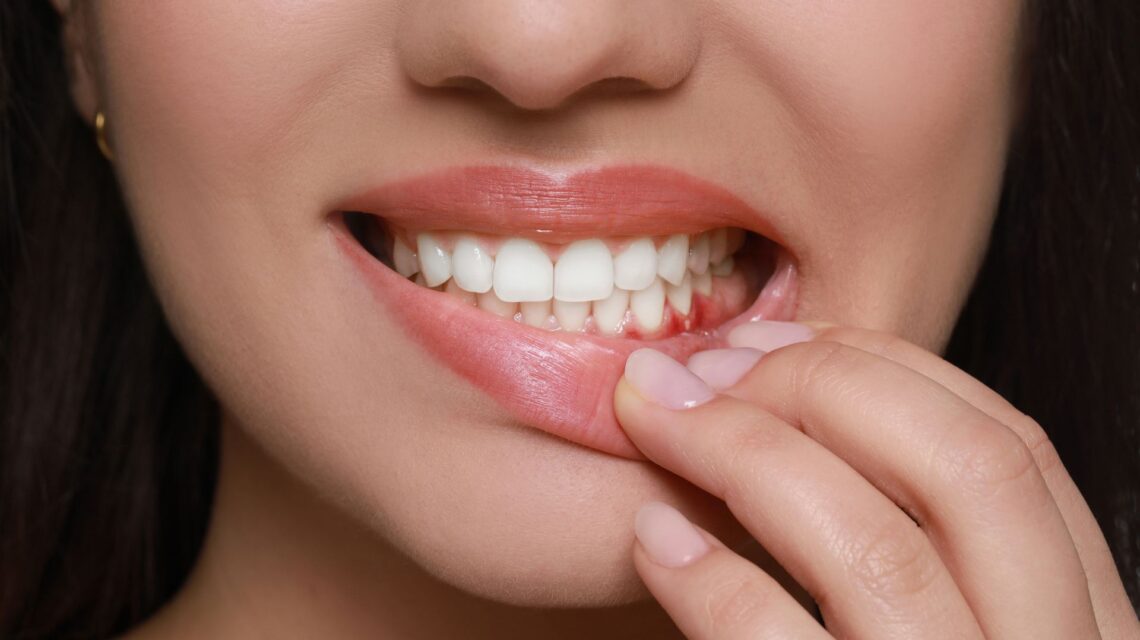 Bleeding Gums & Gum Disease What Are the Signs